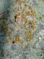 A Stool Containing Undigested Seed, Probable Worm or Protozoa Infestation