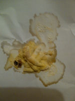 A Single Stool Riddled With Campylobacter